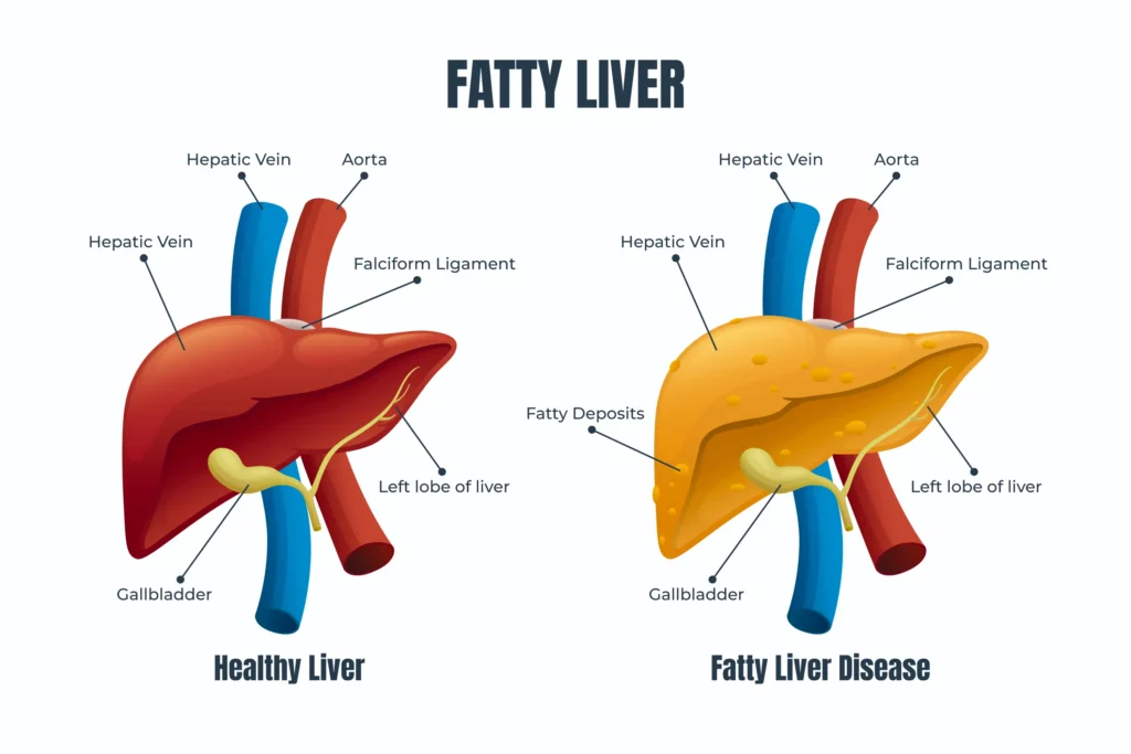 Fatty Liver Diet Plan Pakistan: Reverse Fat Naturally