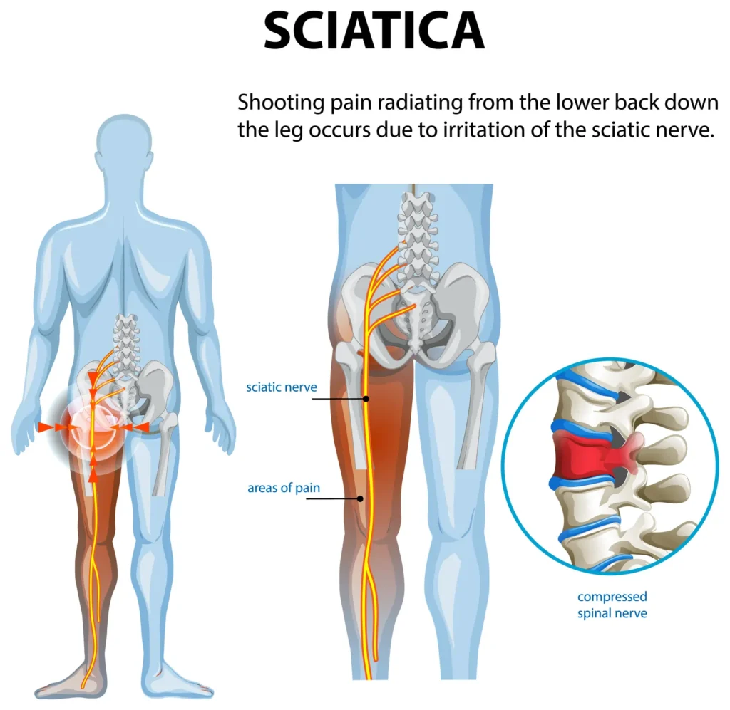 Sciatica and Weight Loss: Reduce Nerve Pressure Naturally