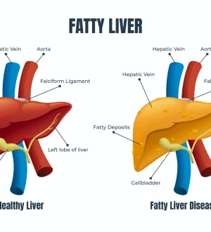 A medical diagram comparing a healthy liver to fatty liver disease to explain the benefits of a Fatty Liver Diet Plan in Pakistan.