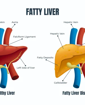 A medical diagram comparing a healthy liver to fatty liver disease to explain the benefits of a Fatty Liver Diet Plan in Pakistan.