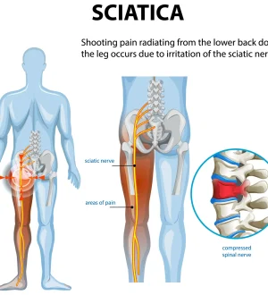 Medical illustration showing sciatica pain radiating from the lower back down the leg due to a compressed spinal nerve, highlighting why reducing spinal pressure through weight loss is effective.