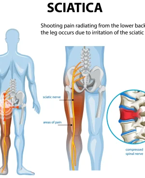 Medical illustration showing sciatica pain radiating from the lower back down the leg due to a compressed spinal nerve, highlighting why reducing spinal pressure through weight loss is effective.